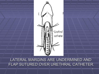 7676
LATERAL MARGINS ARE UNDERMINED ANDLATERAL MARGINS ARE UNDERMINED AND
FLAP SUTURED OVER URETHRAL CATHETER.FLAP SUTURED OVER URETHRAL CATHETER.
 