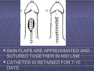 7777
 SKIN FLAPS ARE APPROXIMATED ANDSKIN FLAPS ARE APPROXIMATED AND
SUTURED TOGETHER IN MID LINESUTURED TOGETHER IN MID LINE
 CATHETER IS RETAINED FOR 7-10CATHETER IS RETAINED FOR 7-10
DAYS.DAYS.
 