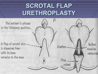 8282
SCROTAL FLAPSCROTAL FLAP
URETHROPLASTYURETHROPLASTY
 