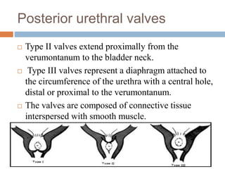 Posterior urethral valves
 Type II valves extend proximally from the
verumontanum to the bladder neck.
 Type III valves represent a diaphragm attached to
the circumference of the urethra with a central hole,
distal or proximal to the verumontanum.
 The valves are composed of connective tissue
interspersed with smooth muscle.
 
