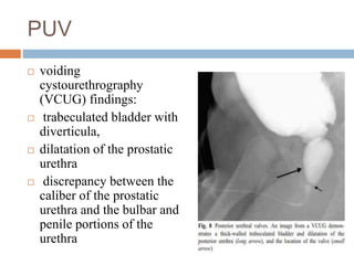 PUV
 voiding
cystourethrography
(VCUG) findings:
 trabeculated bladder with
diverticula,
 dilatation of the prostatic
urethra
 discrepancy between the
caliber of the prostatic
urethra and the bulbar and
penile portions of the
urethra
 