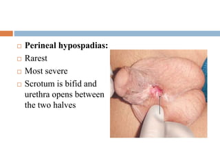  Perineal hypospadias:
 Rarest
 Most severe
 Scrotum is bifid and
urethra opens between
the two halves
 