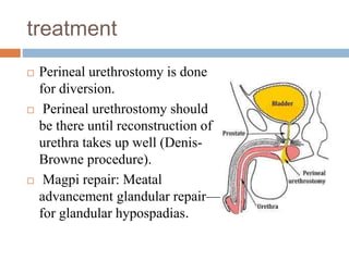 treatment
 Perineal urethrostomy is done
for diversion.
 Perineal urethrostomy should
be there until reconstruction of
urethra takes up well (Denis-
Browne procedure).
 Magpi repair: Meatal
advancement glandular repair—
for glandular hypospadias.
 