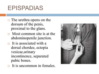 EPISPADIAS
 The urethra opens on the
dorsum of the penis,
proximal to the glans.
 Most common site is at the
abdominopenile junction.
 It is associated with a
dorsal chordee, ectopia
vesicae,urinary
incontinence, separated
pubic bones.
 It is uncommon in females.
 