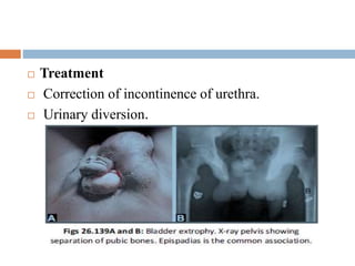  Treatment
 Correction of incontinence of urethra.
 Urinary diversion.
 