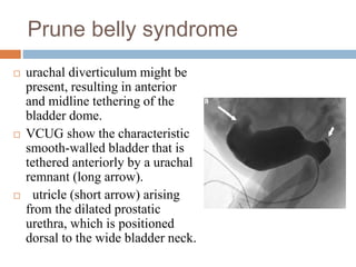 Prune belly syndrome
 urachal diverticulum might be
present, resulting in anterior
and midline tethering of the
bladder dome.
 VCUG show the characteristic
smooth-walled bladder that is
tethered anteriorly by a urachal
remnant (long arrow).
 utricle (short arrow) arising
from the dilated prostatic
urethra, which is positioned
dorsal to the wide bladder neck.
 