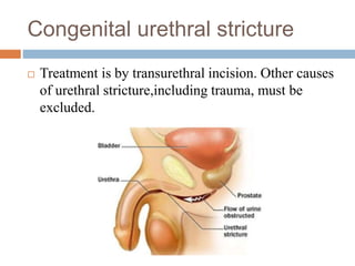 Congenital urethral stricture
 Treatment is by transurethral incision. Other causes
of urethral stricture,including trauma, must be
excluded.
 