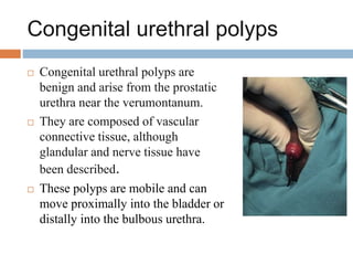 Congenital urethral polyps
 Congenital urethral polyps are
benign and arise from the prostatic
urethra near the verumontanum.
 They are composed of vascular
connective tissue, although
glandular and nerve tissue have
been described.
 These polyps are mobile and can
move proximally into the bladder or
distally into the bulbous urethra.
 