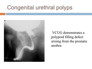 Congenital urethral polyps
VCUG demonstrates a
polypoid filling defect
arising from the prostatic
urethra
 