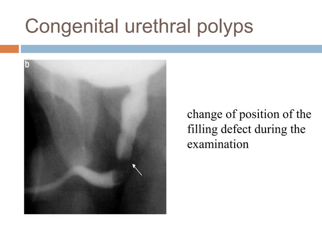 Urethral anomalies | PPTX