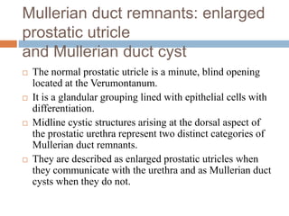 Mullerian duct remnants: enlarged
prostatic utricle
and Mullerian duct cyst
 The normal prostatic utricle is a minute, blind opening
located at the Verumontanum.
 It is a glandular grouping lined with epithelial cells with
differentiation.
 Midline cystic structures arising at the dorsal aspect of
the prostatic urethra represent two distinct categories of
Mullerian duct remnants.
 They are described as enlarged prostatic utricles when
they communicate with the urethra and as Mullerian duct
cysts when they do not.
 