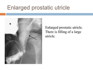 Enlarged prostatic utricle
Enlarged prostatic utricle.
There is filling of a large
utricle.
 