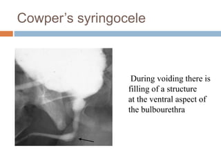 Cowper’s syringocele
During voiding there is
filling of a structure
at the ventral aspect of
the bulbourethra
 