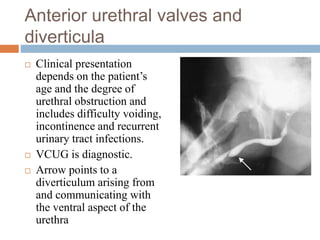 Anterior urethral valves and
diverticula
 Clinical presentation
depends on the patient’s
age and the degree of
urethral obstruction and
includes difficulty voiding,
incontinence and recurrent
urinary tract infections.
 VCUG is diagnostic.
 Arrow points to a
diverticulum arising from
and communicating with
the ventral aspect of the
urethra
 