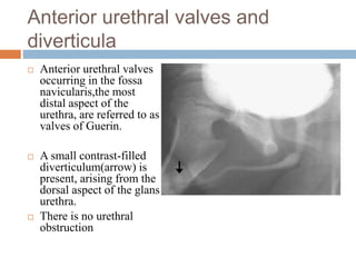 Anterior urethral valves and
diverticula
 Anterior urethral valves
occurring in the fossa
navicularis,the most
distal aspect of the
urethra, are referred to as
valves of Guerin.
 A small contrast-filled
diverticulum(arrow) is
present, arising from the
dorsal aspect of the glans
urethra.
 There is no urethral
obstruction
 
