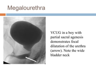 Megalourethra
VCUG in a boy with
partial sacral agenesis
demonstrates focal
dilatation of the urethra
(arrow). Note the wide
bladder neck
 