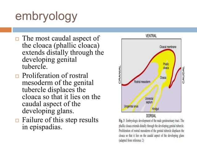 Urethral anomalies | PPTX