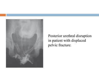 Posterior urethral disruption
in patient with displaced
pelvic fracture.
 
