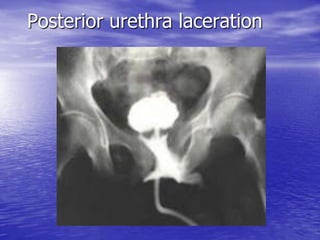 Posterior urethra laceration
 
