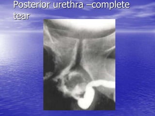 Posterior urethra –complete
tear
 