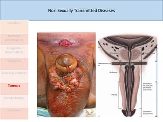 Non Sexually Transmitted Diseases
Infections
Anatomic
abnormalities
Congenital
abnormalities
Iatrogenic
Chemical irritation
Tumors
Foreign bodies
Unknown
 