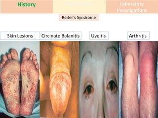 History Examination Laboratory
Investigations
Reiter’s Syndrome
Skin Lesions Circinate Balanitis Uveitis Arthritis
 