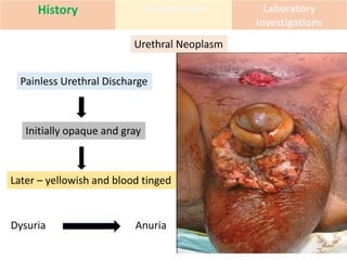 History Examination Laboratory
Investigations
Urethral Neoplasm
Painless Urethral Discharge
Initially opaque and gray
Later – yellowish and blood tinged
Dysuria Anuria
 