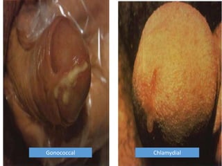 Gonococcal Chlamydial
 