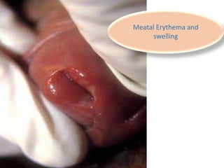 Meatal Erythema and
swelling
 
