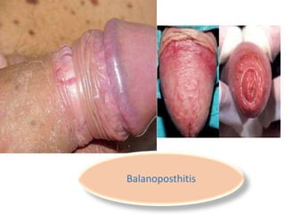 Balanoposthitis
 