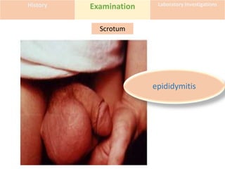 History Examination Laboratory Investigations
Scrotum
epididymitis
 