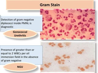 Gram Stain
Detection of gram negative
diplococci inside PMNL is
diagnostic
Presence of greater than or
equal to 2 WBCs per oil
immersion field in the absence
of gram negative
Gonococcal
Urethritis
NGU
 