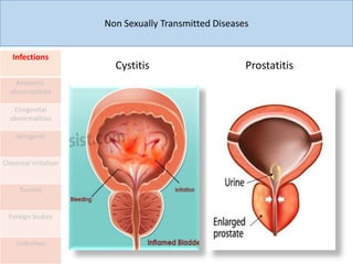 Non Sexually Transmitted Diseases
Infections
Anatomic
abnormalities
Congenital
abnormalities
Iatrogenic
Chemical irritation
Tumors
Foreign bodies
Unknown
Cystitis Prostatitis
 
