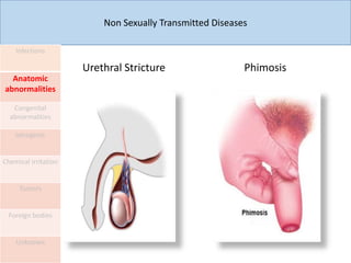 Non Sexually Transmitted Diseases
Infections
Anatomic
abnormalities
Congenital
abnormalities
Iatrogenic
Chemical irritation
Tumors
Foreign bodies
Unknown
Urethral Stricture Phimosis
 