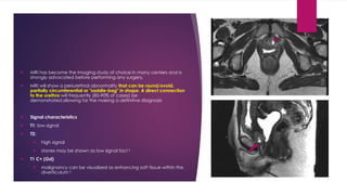 Urethral Diverticulum divertikel t.pptx