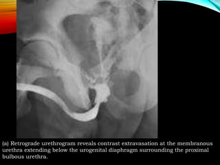 Normal Retrograde Urethrogram Transverse IMAGING OF URETHRAL INJURY | PPTX
