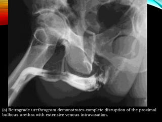IMAGING OF URETHRAL INJURY | PPTX