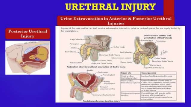 URETHRAL INJURY- Trauma Surgery | PPTX