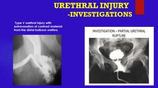 URETHRAL INJURY- Trauma Surgery