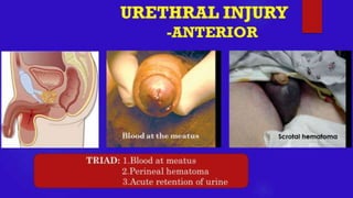 URETHRAL INJURY- Trauma Surgery
