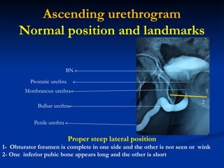 Urethrogram Norma Urethral injuries: anatomical consideration and initial management by ...