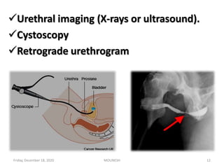 Urethral imaging (X-rays or ultrasound).
Cystoscopy
Retrograde urethrogram
Friday, December 18, 2020 MOUNESH 12
 