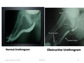 Normal Urethrogram Obstructive Urethrogram
Friday, December 18, 2020 13MOUNESH
 