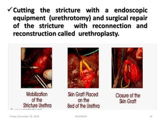 Cutting the stricture with a endoscopic
equipment (urethrotomy) and surgical repair
of the stricture with reconnection and
reconstruction called urethroplasty.
Friday, December 18, 2020 16MOUNESH
 