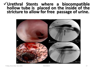 Friday, December 18, 2020 17MOUNESH
Urethral Stents where a biocompatible
hollow tube is placed on the inside of the
stricture to allow for free passage of urine.
 