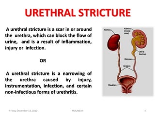URETHRAL STRICTURE
A urethral stricture is a scar in or around
the urethra, which can block the flow of
urine, and is a result of inflammation,
injury or infection.
OR
A urethral stricture is a narrowing of
the urethra caused by injury,
instrumentation, infection, and certain
non-infectious forms of urethritis.
Friday, December 18, 2020 3MOUNESH
 