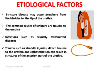 ETIOLOGICAL FACTORS
 Stricture disease may occur anywhere from
the bladder to the tip of the urethra.
 The common causes of stricture are trauma to
the urethra
 Infections such as sexually transmitted
diseases
 Trauma such as straddle injuries, direct trauma
to the urethra and catheterization can result in
strictures of the anterior part of the urethra.
Friday, December 18, 2020 6MOUNESH
 