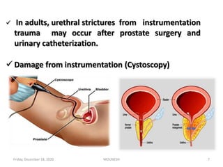  In adults, urethral strictures from instrumentation
trauma may occur after prostate surgery and
urinary catheterization.
 Damage from instrumentation (Cystoscopy)
Friday, December 18, 2020 7MOUNESH
 