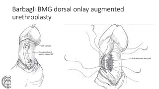 Barbagli BMG dorsal onlay augmented
urethroplasty
 