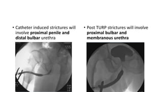 • Catheter induced strictures will
involve proximal penile and
distal bulbar urethra
• Post TURP strictures will involve
proximal bulbar and
membranous urethra
 
